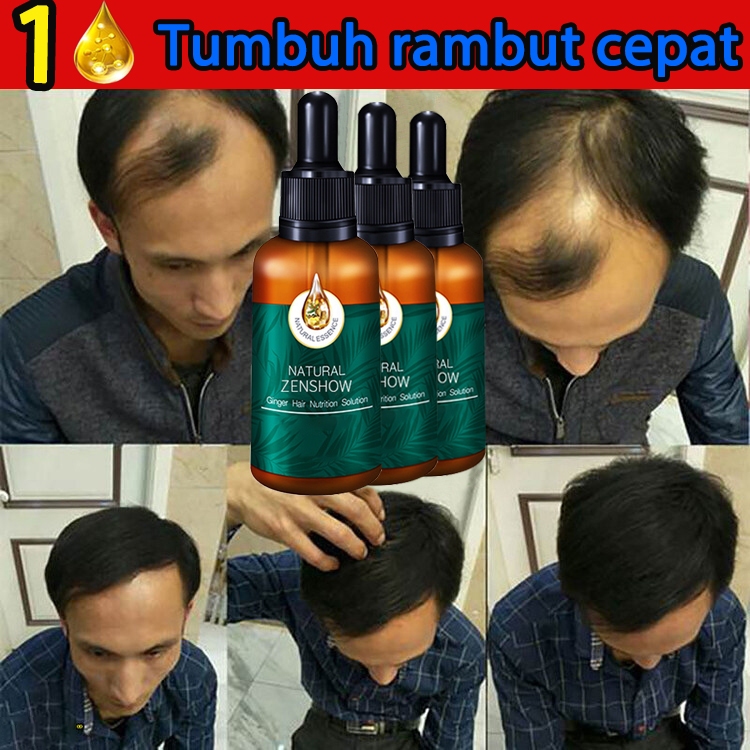 Jual Cairan Penumbuh Rambut Penumbuh Rambut Cepat Dan Tebal Penumbuh