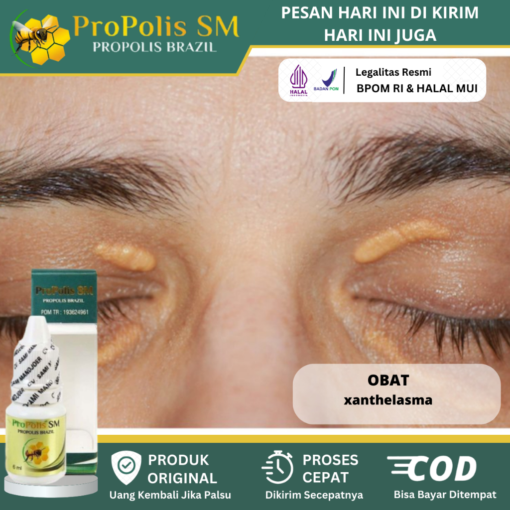 Jual Obat Xanthelasma, Penghilang Gumpalan Lemak Di Kelopak Mata ...