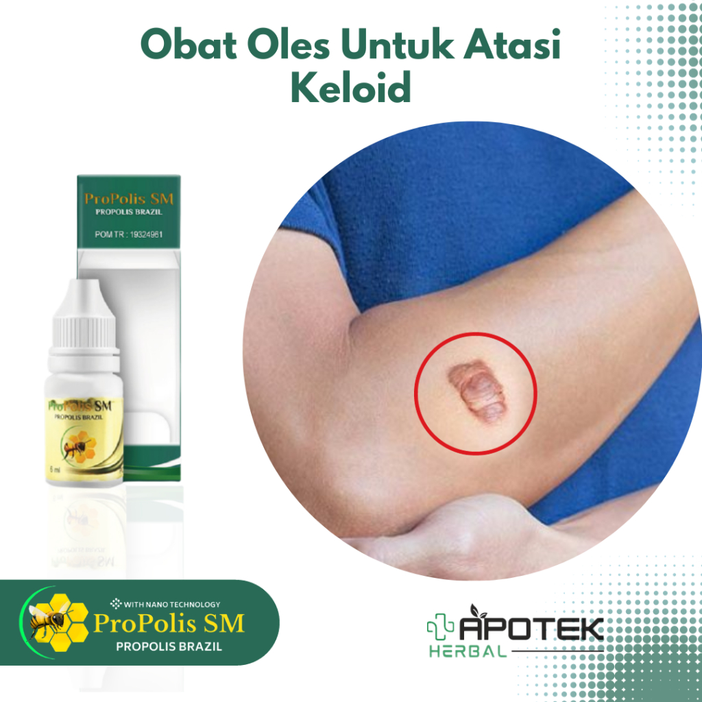 Jual Obat Keloid Daging Jadi Daging Tumbuh Keloid Bekas Operasi Keloid ...