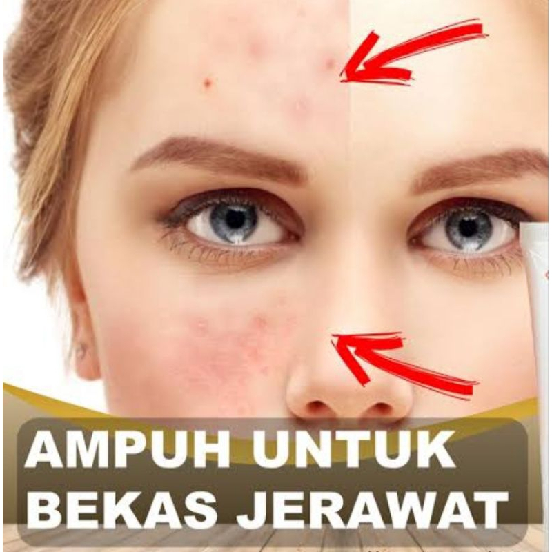 Jual Dermakel Gel 19 gram Penghilang Bekas Luka/keloid/Scar Bopeng ...