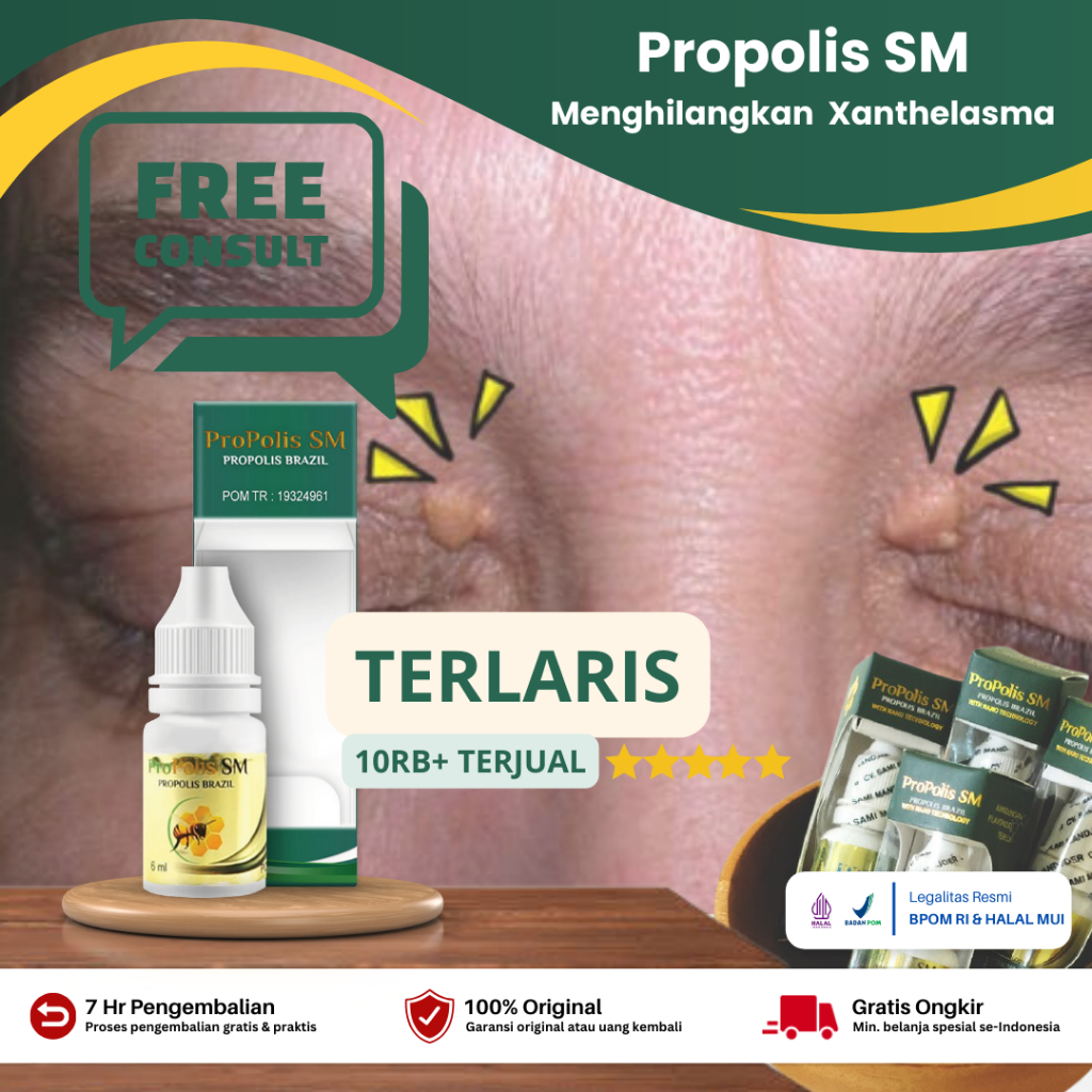 Jual Propolis SM - Obat Xanthelasma, Penghilang Gumpalan Lemak Di ...