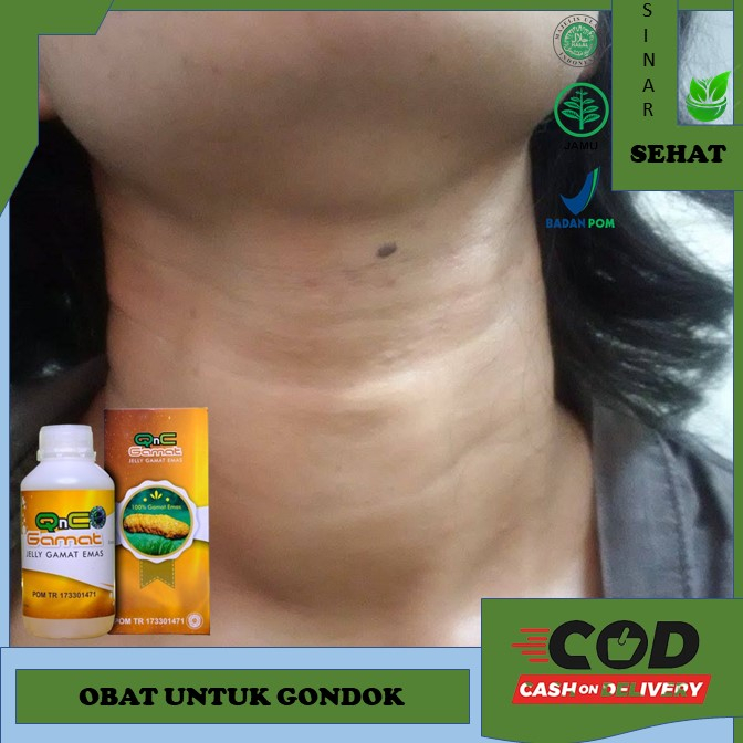 Jual obat gondok Obat Untuk Benjolan Dileher Obat Gondok Kelenjar