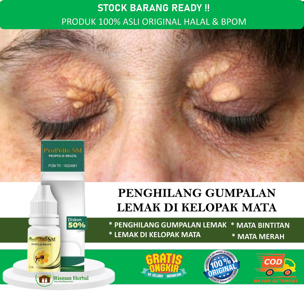 Jual Propolis Sm Obat Penghilang Gumpalan Lemak Di Kelopak Mata ...