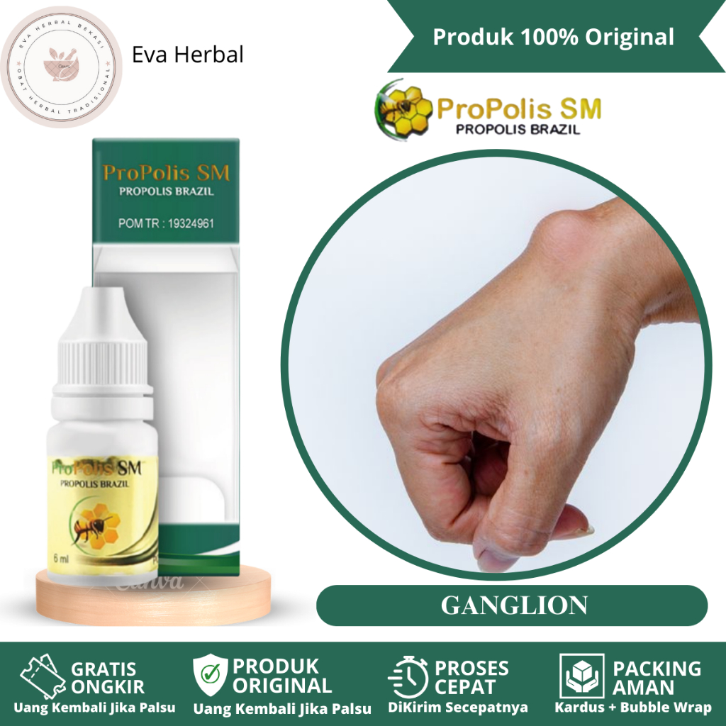 Jual Obat Benjolan Di Tangan, Kista Ganglion, Penghancur Benjolan ...