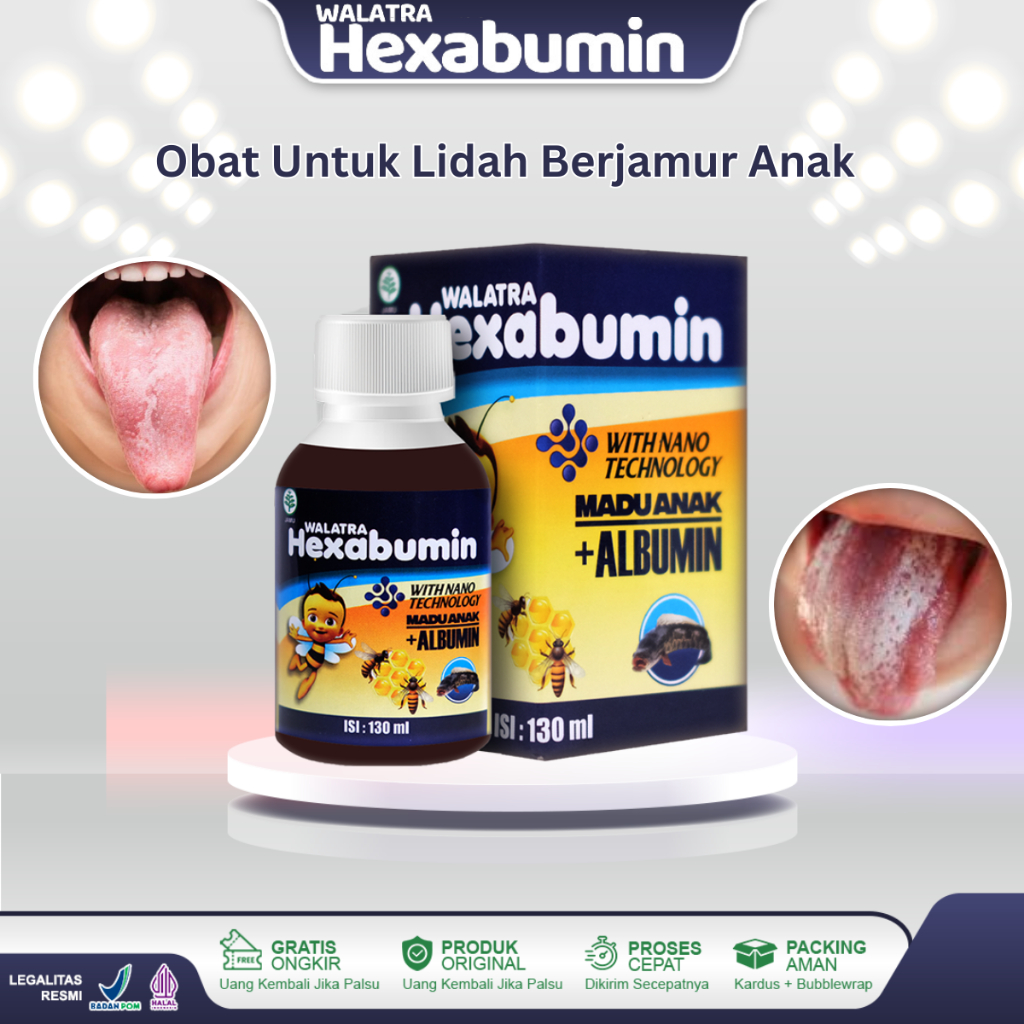 Jual Obat Jamur Lidah Anak Candidiasis Lidah Mati Rasa Infeksi Candida ...