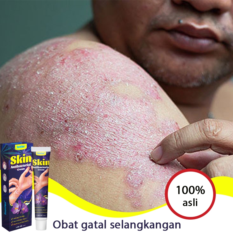 Jual salep jamur kulit salep eksim salep gatal paling ampuh salep gatal
