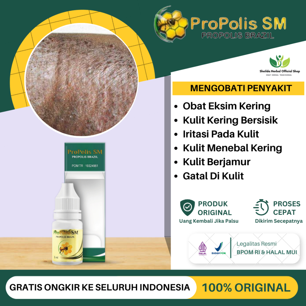 Jual Obat Eksim Kering Menahun, Eksim Basah, Gatal Gatal Seluruh Badan ...