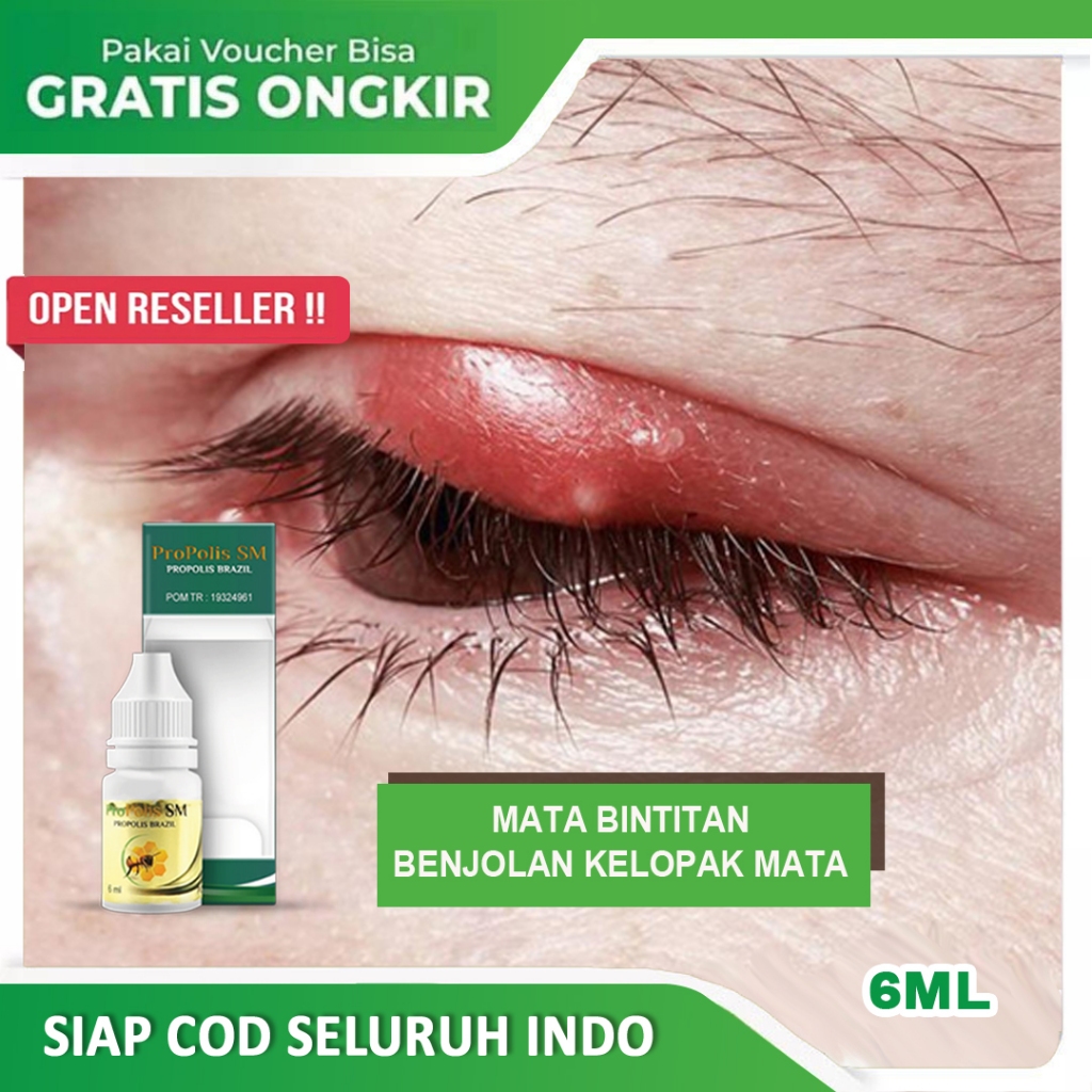 Jual Obat Mata Bintitan Kalazion Pada Anak Dan Dewasa Hordeolum Mata ...