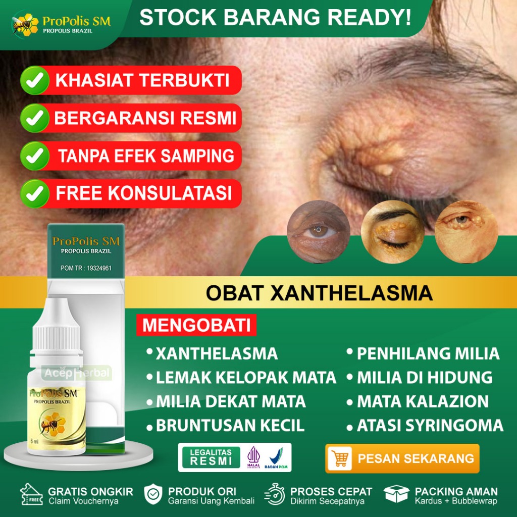 Jual Obat Xanthelasma Lemak Kelopak Mata Milia Dekat Mata Bruntusan