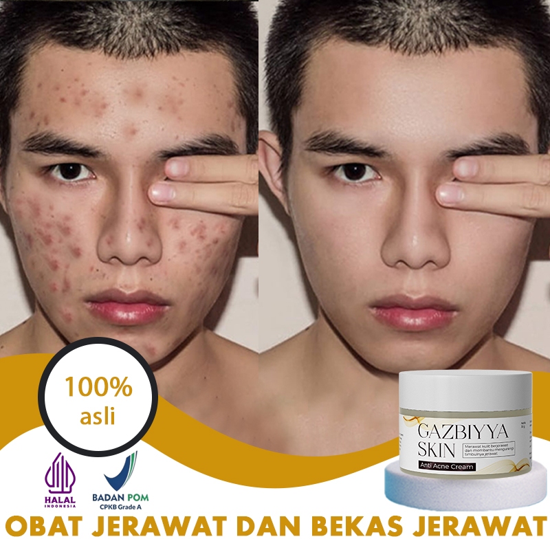 Jual Penghilang jerawat obat jerawat dan bekas jerawat penghilang bekas