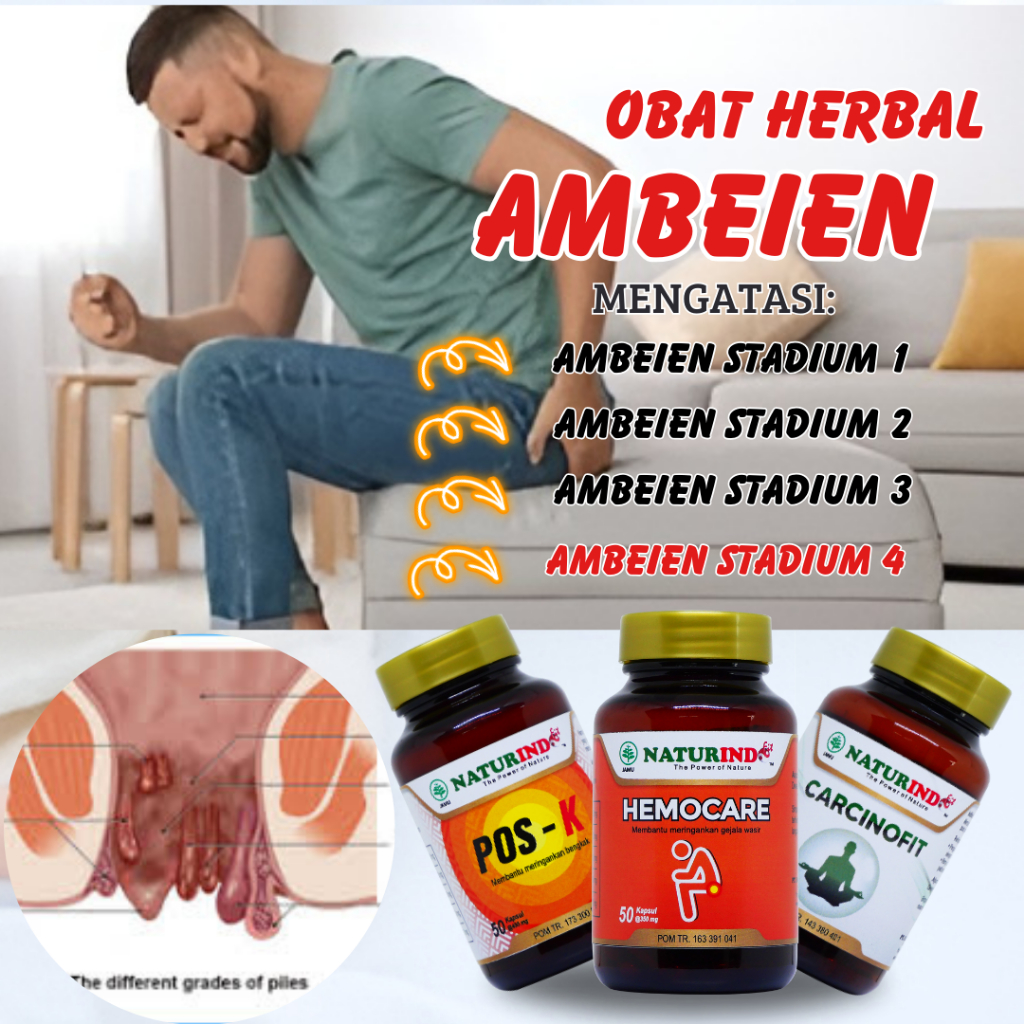 Jual Obat Wasir Ambeien Ambeyen Luar Dalam Susah BAB Stadium 1 2 3 4