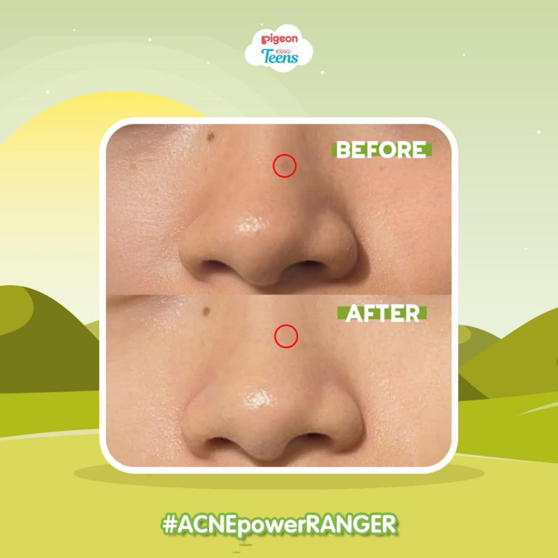 Jual Pigeon Teens 1 Paket Lengkap Acne Ranger Full Power | Shopee Indonesia