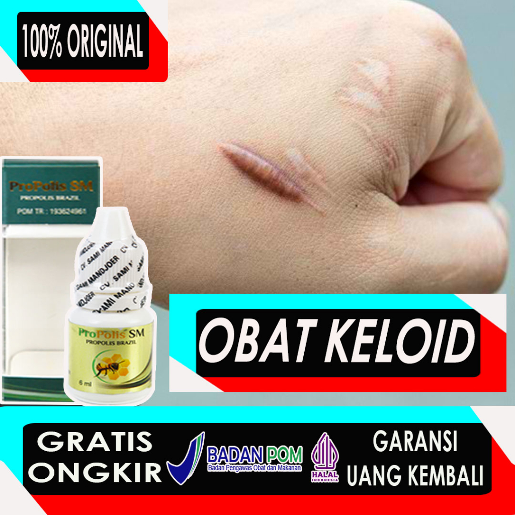 Jual Propolis Sm Obat Keloid Obat Unttuk Menghilangkan Keloid
