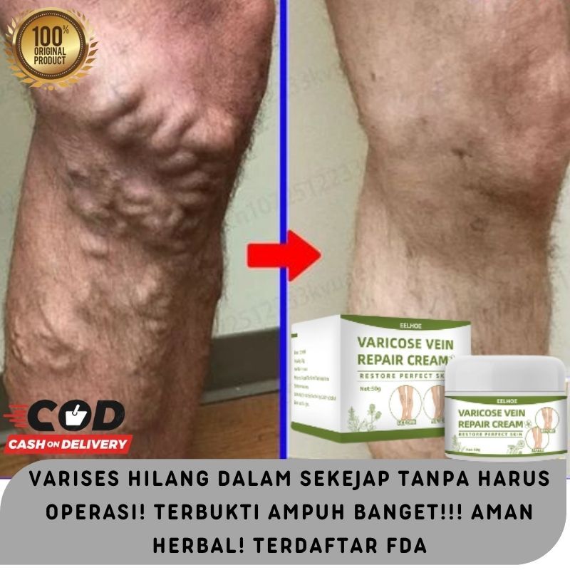 Varises Pada Kaki Apa Obatnya