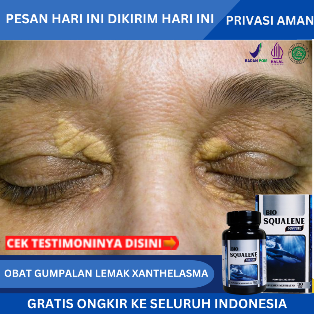 Jual Obat Xanthelasma, Penghilang Gumpalan Lemak Di Kelopak Mata, Obat ...