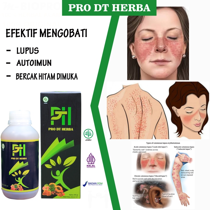 Jual Obat Kulit Herbal Lupus Autoimun Paling Ampuh Pro Dt Herba