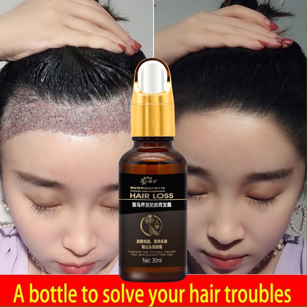 Jual Penumbuh rambut botak Serum penumbuh rambut 30ml Penumbuh rambut ...