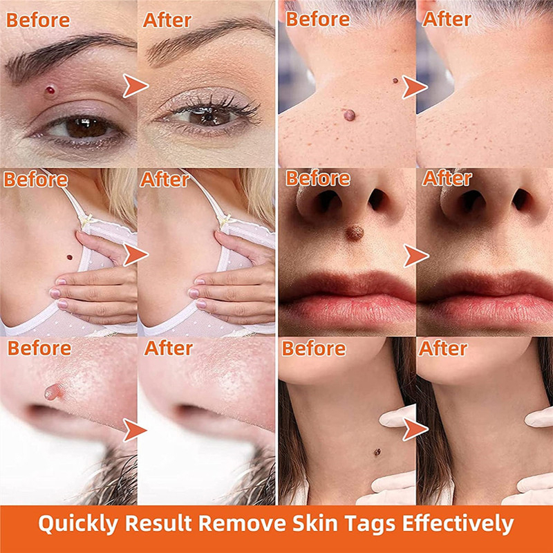 Jual Penghilang Tahi Lalat Penghilang Kutil Skin Tag Remover Obat kutil ...