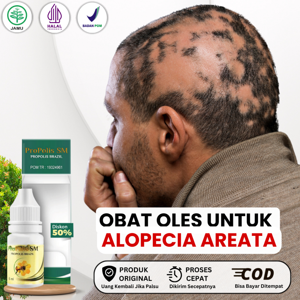 Jual Obat Alopecia Areata Rambut Pitak Penumbuh Rambut Pitak Botak