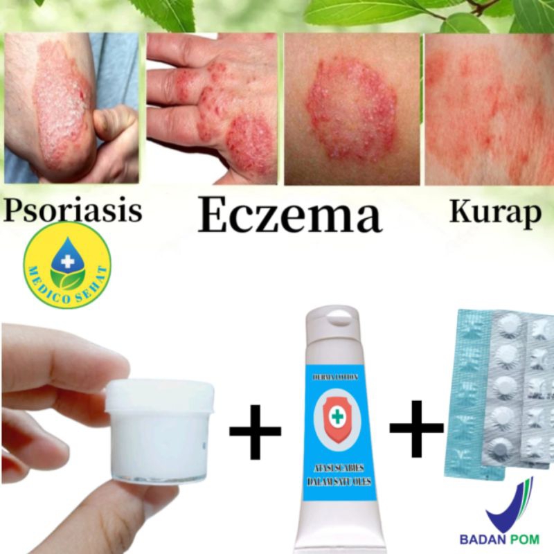 Jual PAKET SEMBUH EKSIM DAN SCABIES ISI SALEP 10GR LOTION DAN TABLET 30 ...