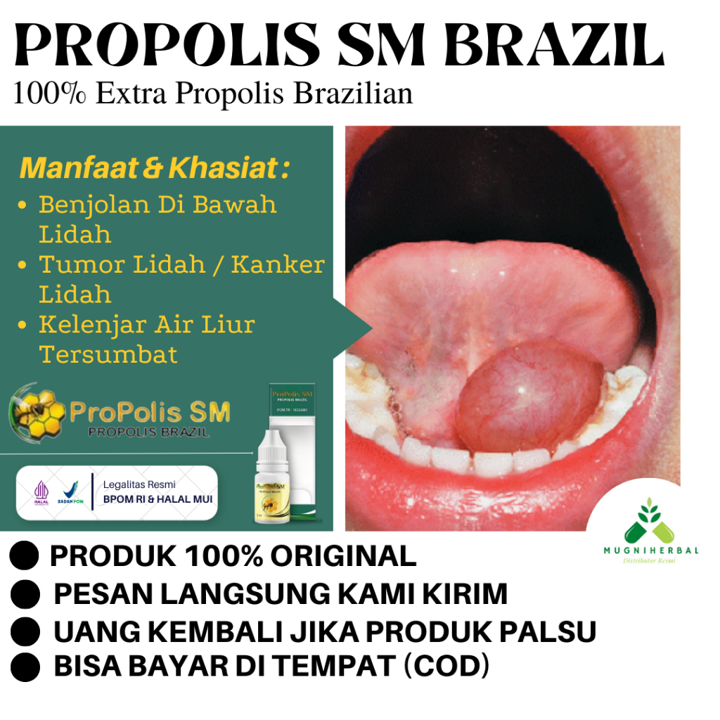 Jual Obat Benjolan Di Bawah Lidah, Benjolan Di Langit Langit Mulut