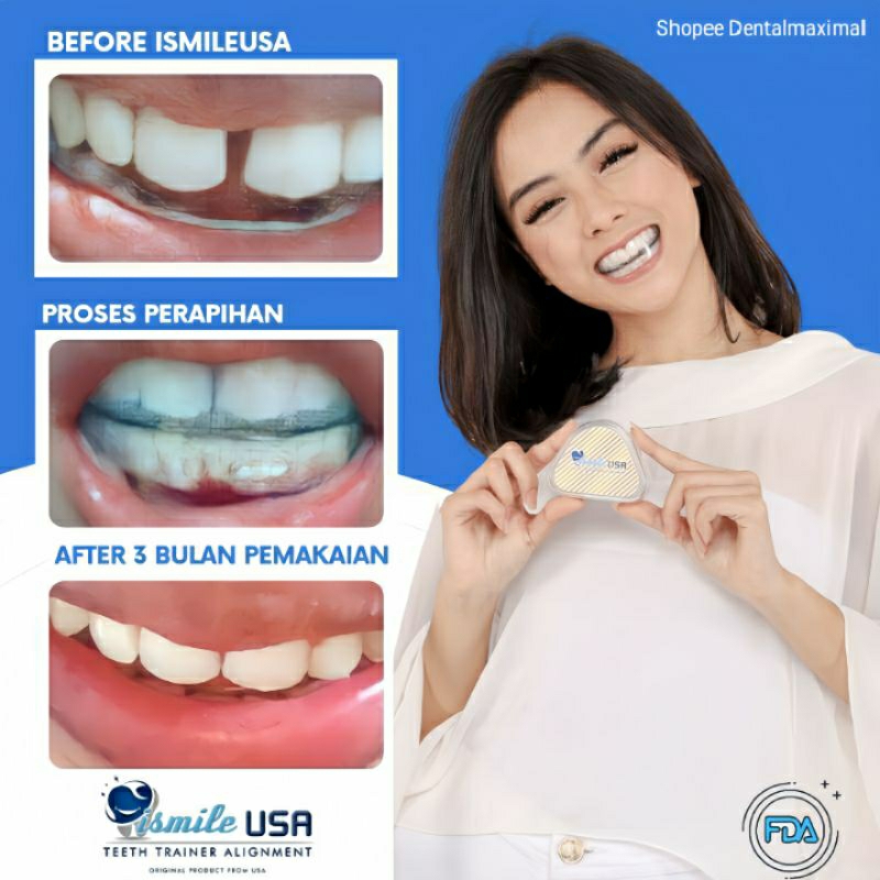 Jual Perapi Gigi Original Ismile USA/Perapih Gigi /Perapat Gigi/Alat ...