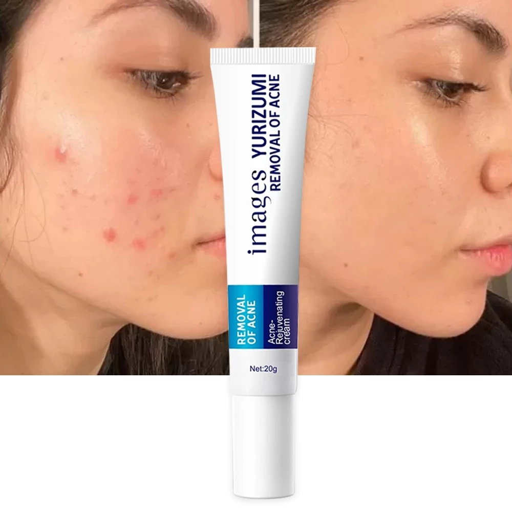 Krim Penghilang Jerawat dan Bekas nya di Wajah dan Mencerahkan 20gr Obat Totol Jerawat Ampuh | AutoStock