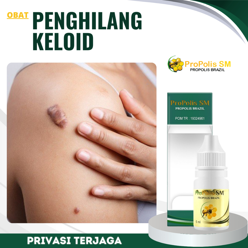 Jual Obat Penghilang Keloid, Obat Keloid Bekas Operasi, Obat Keloid ...