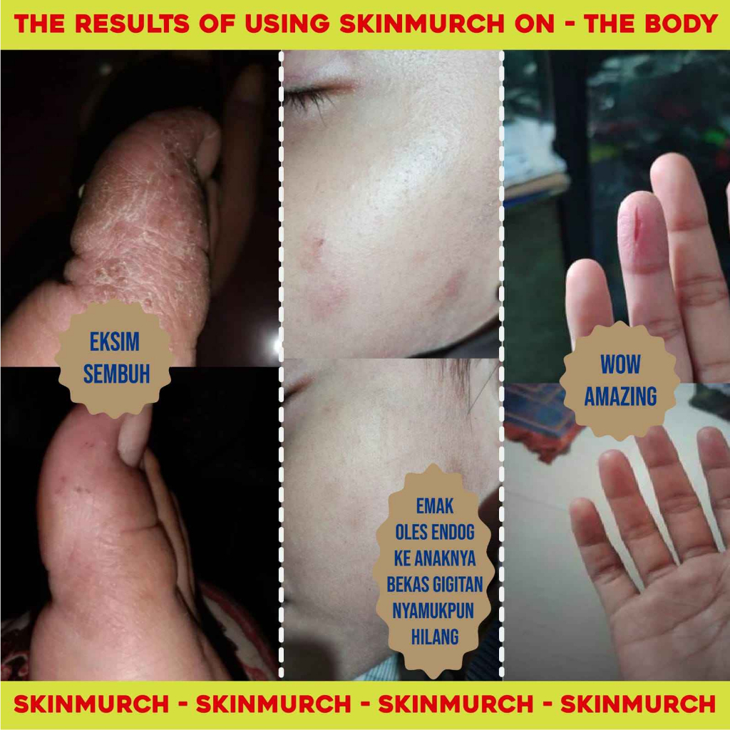 Jual (READY) SKINMURCH Multi Action Treatment Cream | Retinal Chroma ...