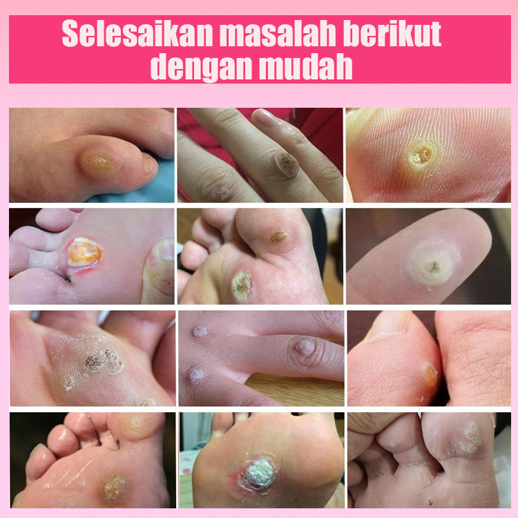 Jual Plester Kutil warts remover patch Plester Mata lkan dan Kutil Foot ...