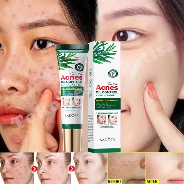 Jual Cream Penghilang Jerawat 20g Penghilang Bekas Jerawat Ampuh/Crim