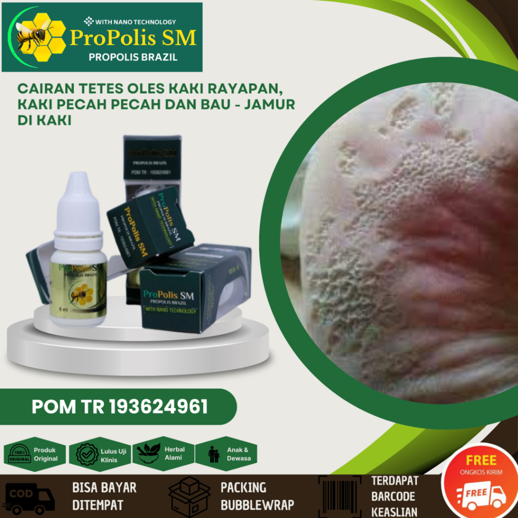 Jual Obat Salep Oles Kaki Rayapan Kutu Air Telapak Kaki Bolong-Bolong ...