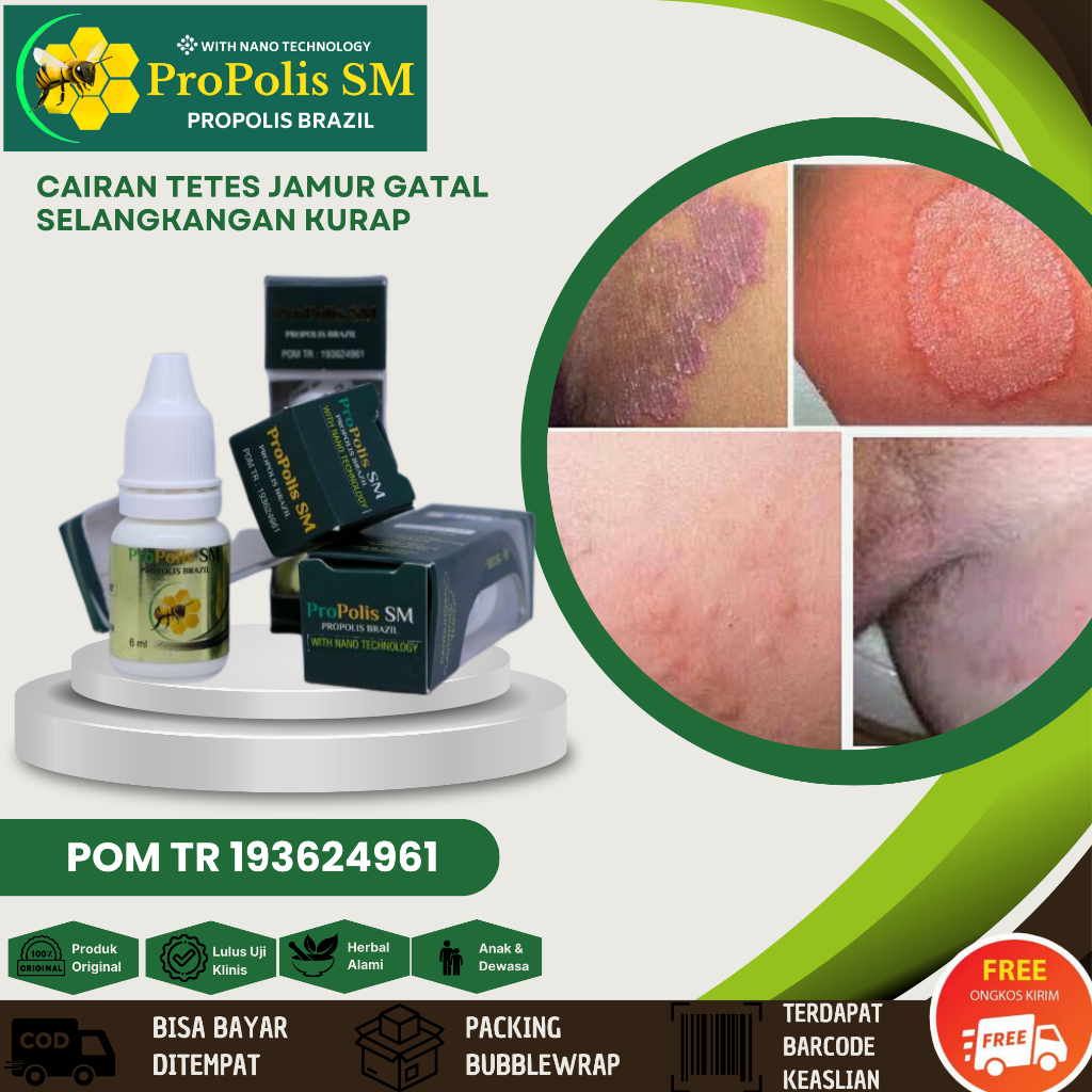 Jual Obat Eksim Kering Menahun Borok Budug Bernanah Berair Bau Gatal Infeksi Jamur Ruam 8214