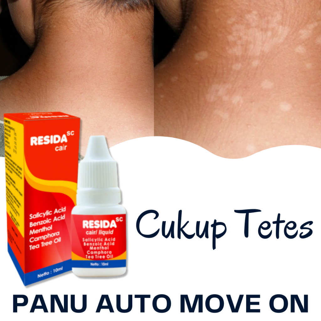 Jual Resida Cair Obat Panu Paling Ampuh 100% / Salep Cream Obat Kadas ...