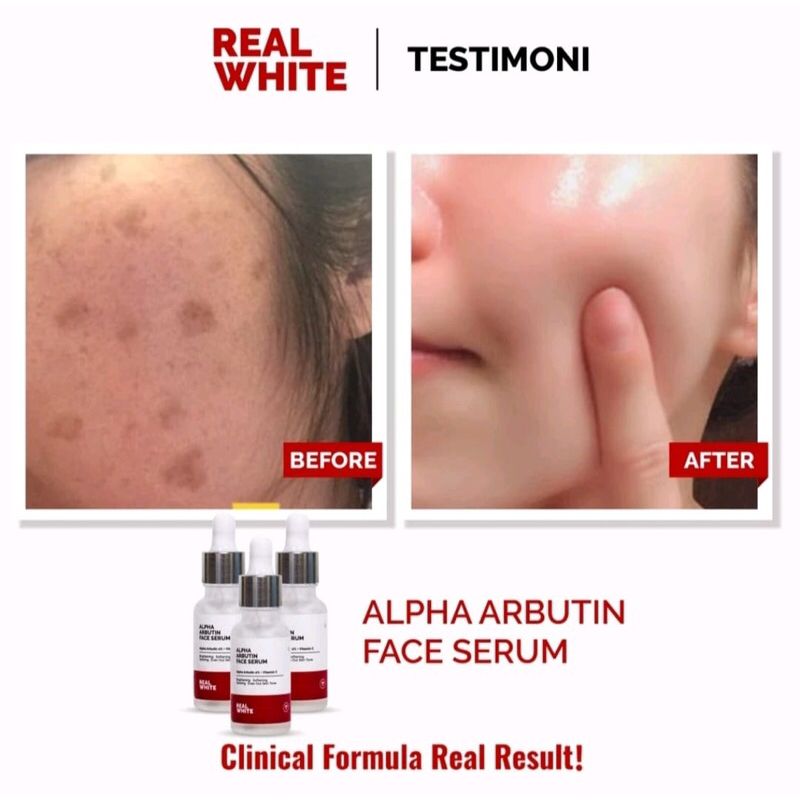 Jual REAL WHITE ALPHA ARBUTIN SERUM.BPOM HALAL SKINCARE WHITENING