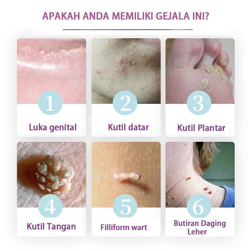 Jual Obat kutil penghilang kutil dan tahi lalat obat kutil paling ampuh ...