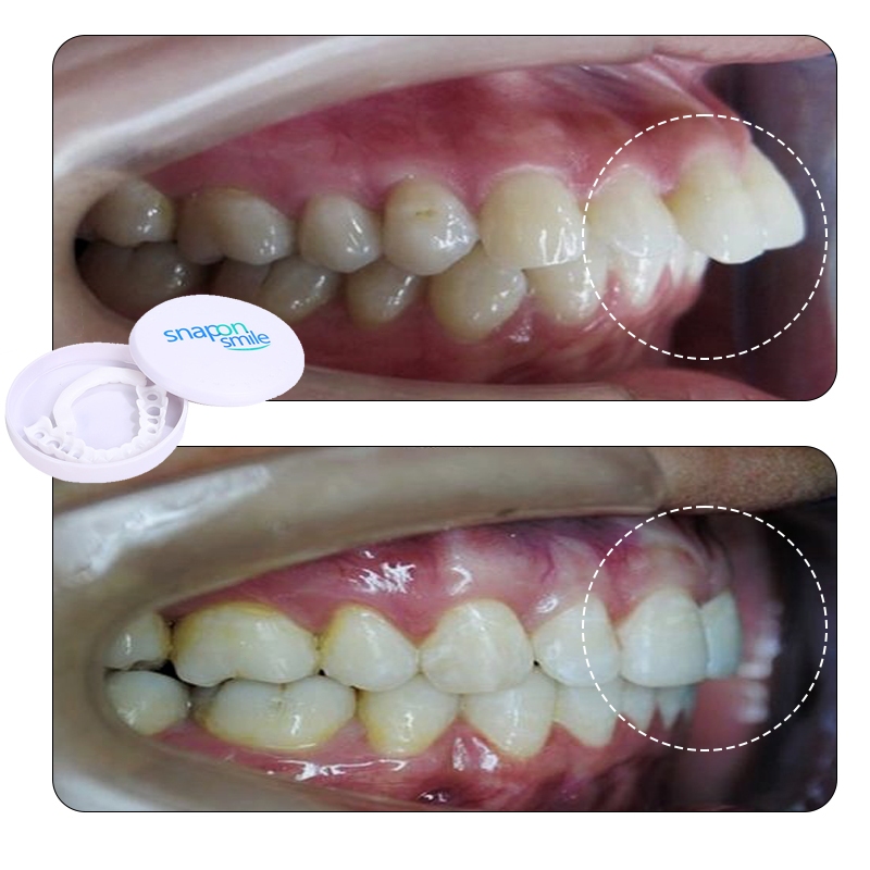 Jual Aligner Gigi Terlengkap & Harga Terbaru Agustus 2026 | Shopee ...