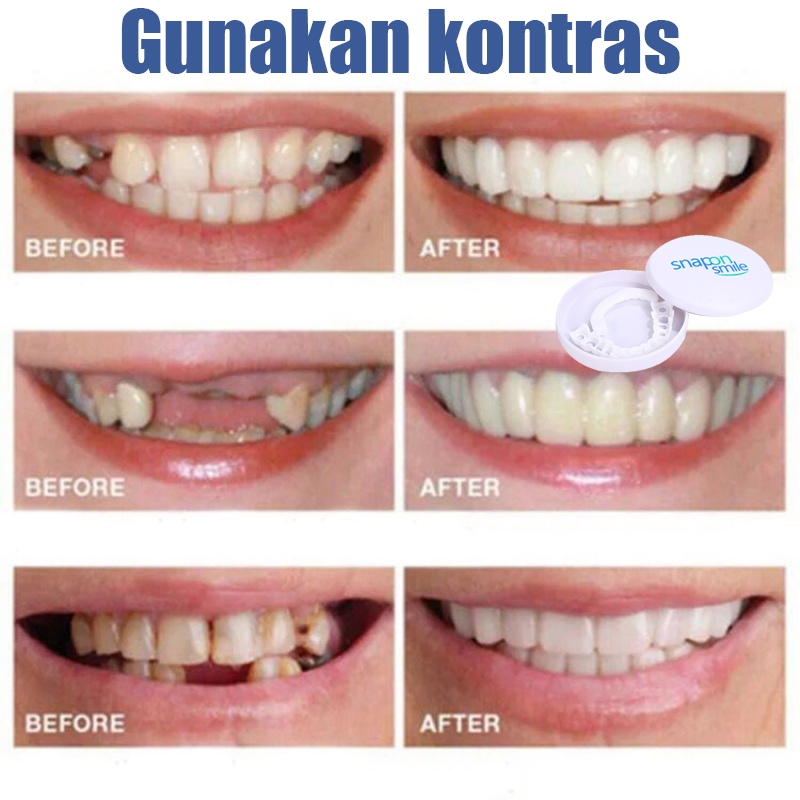 Jual Perapih gigi Aligner gigi Behel gigi original asli dokter Perata ...
