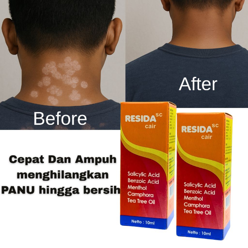 Jual RESIDA Cair Penghilang Panu Kurap Kadas Kutu Air Dan Gatal-gatal ...