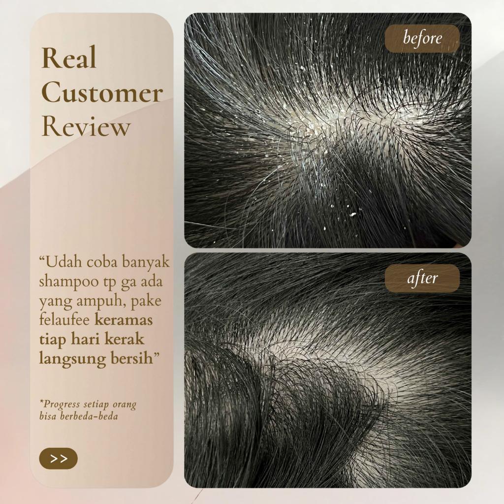 Jual [MW] Felaufee Dandruff Treatment Serum Shampoo Anti Ketombe dan ...