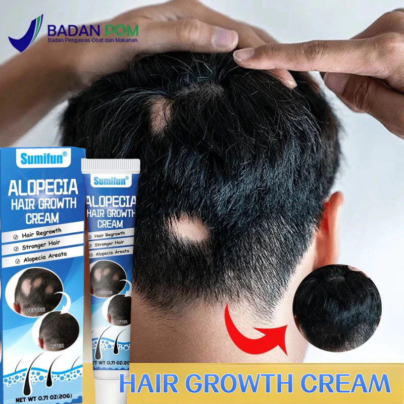 Jual Obat Alopecia Areata 20g Penumbuh Rambut Botak Paling Ampuh Dan ...