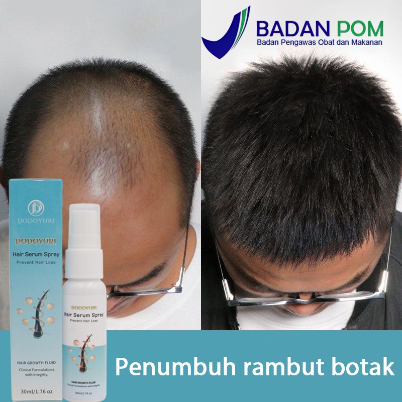 Jual Obat penumbuh rambut minyak penumbuh rambut cepat serum rambut ...
