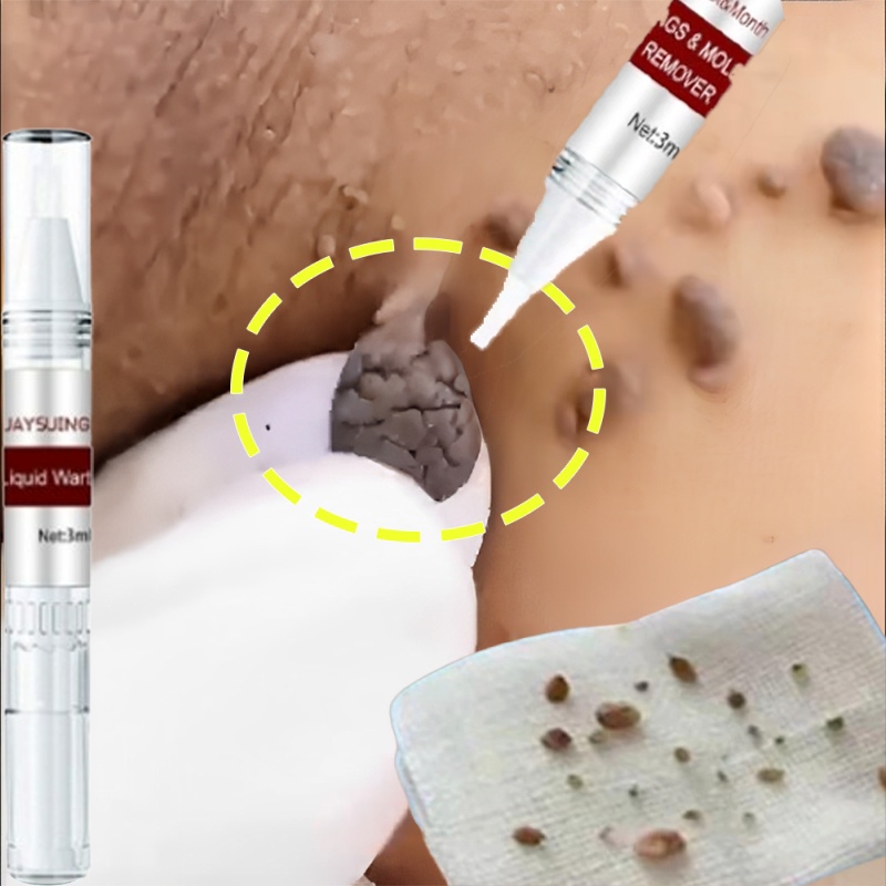 Jual Obat kutil kelamin Penghilang kutil dan tahi lalat Penghilang ...
