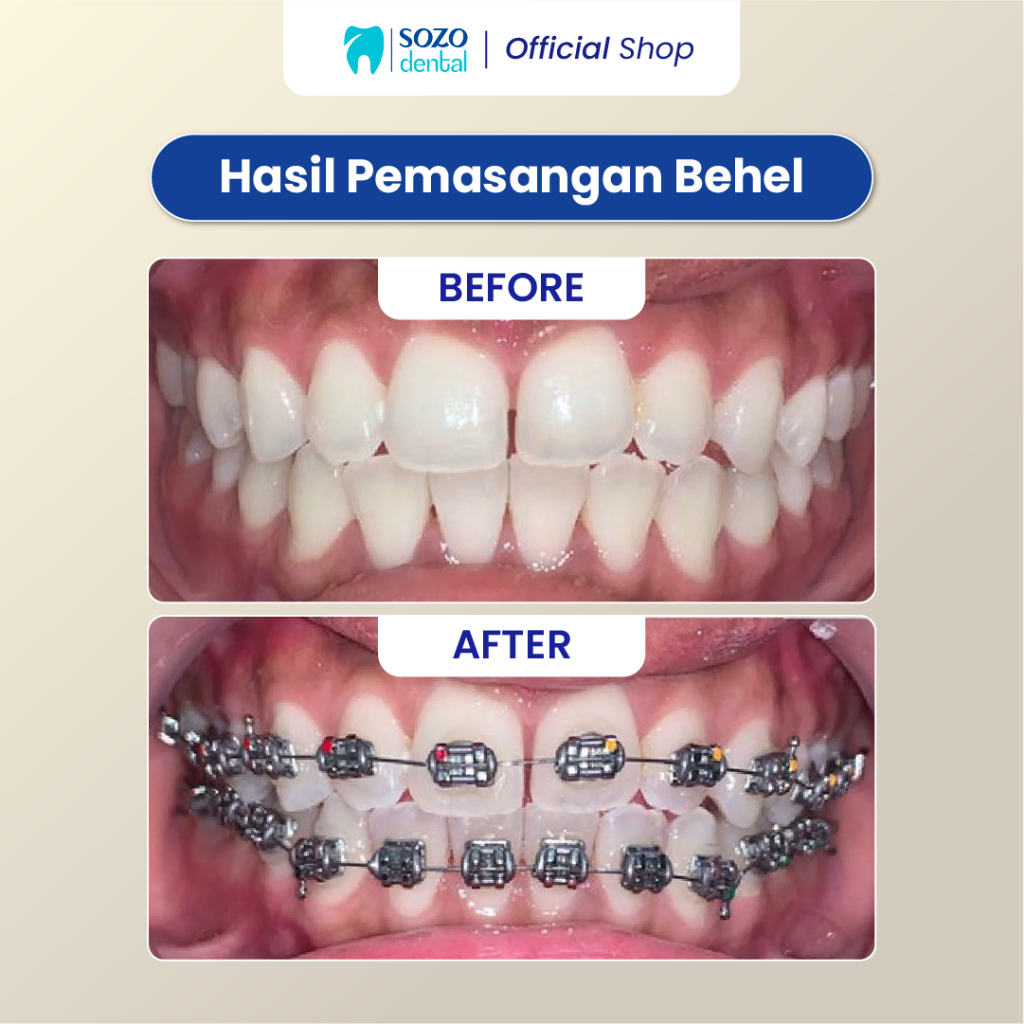 Jual Sozo Dental - Paket Behel Metal PREMIUM Komplit: Pemasangan Rahang ...