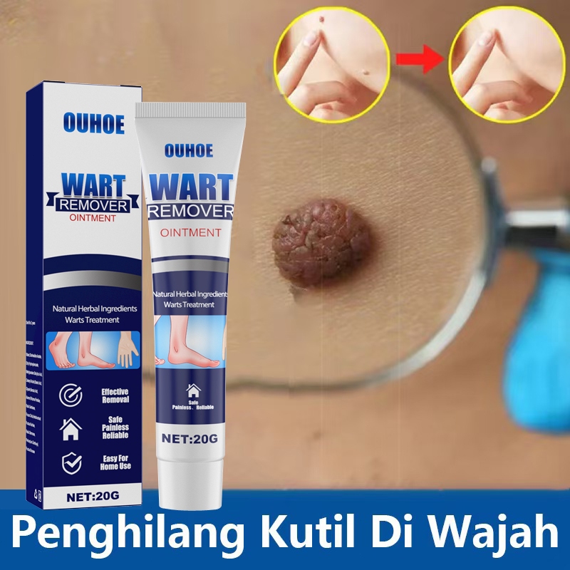 Jual Salep Obat Kutil Paling Wart Removal Cream Penghilang Tahi Lalat ...