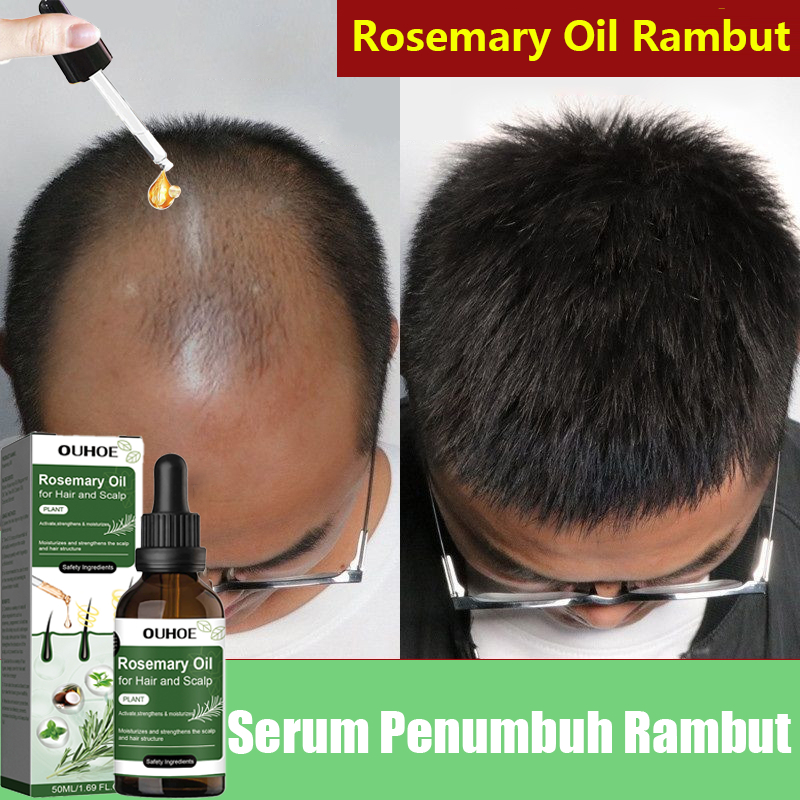 Jual Serum Penumbuh Rambut Botak Rosemary Oil Rambut Obat Penumbuh ...