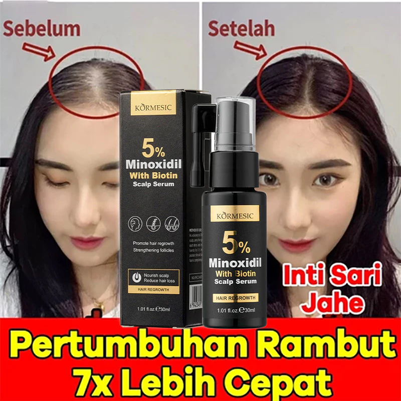 Jual Minoxidil 5% Penumbuh Rambut Obat Penumbuh Rambut Botak, Tipis Dan ...