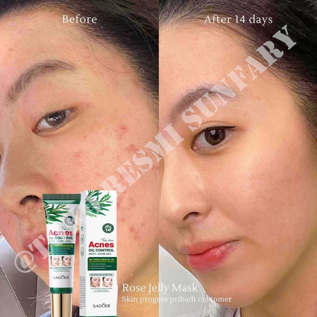 Jual Obat jerawat dan bekas jerawat penghilang bekas jerawat salep