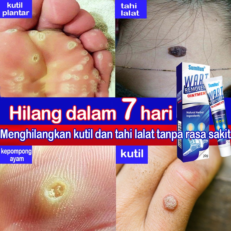 Jual Penghilang kutil Salep kutil Penghilang Kutil Leher Obat kutil ...