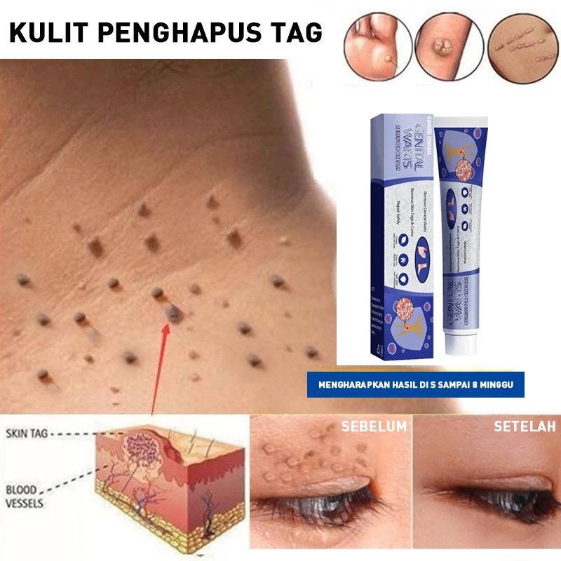 Jual Obat Kutil Kelamin Pria Wanita Penghilang Kutil Kelaminobat Kutil Kelamin Hpv